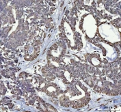 IHC staining of FFPE human ovarian cancer tissue with RTCB antibody. HIER: boil tissue sections in pH8 EDTA for 20 min and allow to cool before testing.