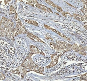 IHC staining of FFPE human parotid acinar cell carcinoma tissue with RTCB antibody. HIER: boil tissue sections in pH8 EDTA for 20 min and allow to cool before testing.