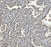 IHC staining of FFPE human lung cancer tissue with RTCB antibody. HIER: boil tissue sections in pH8 EDTA for 20 min and allow to cool before testing.