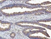 IHC staining of FFPE human colorectal adenocarcinoma tissue with TSEN54 antibody. HIER: boil tissue sections in pH8 EDTA for 20 min and allow to cool before testing.
