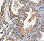 IHC staining of FFPE human endometrial cancer tissue with RPS28 antibody. HIER: boil tissue sections in pH8 EDTA for 20 min and allow to cool before testing.