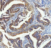 IHC staining of FFPE human colon cancer tissue with RPS28 antibody. HIER: boil tissue sections in pH8 EDTA for 20 min and allow to cool before testing.