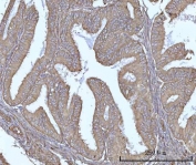 IHC staining of FFPE human endometrioid adenocarcinoma tissue with SSBP1 antibody. HIER: boil tissue sections in pH8 EDTA for 20 min and allow to cool before testing.