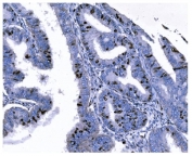 IHC staining of FFPE human cervical cancer tissue with Ki67 antibody. HIER: boil tissue sections in pH8 EDTA for 20 min and allow to cool before testing.