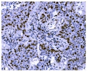 IHC staining of FFPE human lung cancer tissue with Ki67 antibody. HIER: boil tissue sections in pH8 EDTA for 20 min and allow to cool before testing.