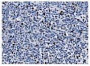 IHC staining of FFPE human lymphoma tissue with Ki67 antibody. HIER: boil tissue sections in pH8 EDTA for 20 min and allow to cool before testing.