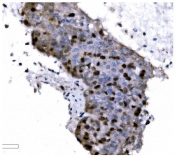 IHC staining of FFPE human liver cancer tissue with Ki67 antibody. HIER: boil tissue sections in pH8 EDTA for 20 min and allow to cool before testing.