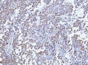 IHC staining of FFPE human lung adenocarcinoma tissue with TMEM87A antibody. HIER: boil tissue sections in pH8 EDTA for 20 min and allow to cool before testing.