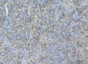 IHC staining of FFPE human testicular seminoma tissue with TMEM87A antibody. HIER: boil tissue sections in pH8 EDTA for 20 min and allow to cool before testing.