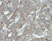 IHC staining of FFPE human liver cancer tissue with TMEM87A antibody. HIER: boil tissue sections in pH8 EDTA for 20 min and allow to cool before testing.