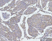 IHC staining of FFPE human esophageal squamous carcinoma tissue with TMEM87A antibody. HIER: boil tissue sections in pH8 EDTA for 20 min and allow to cool before testing.