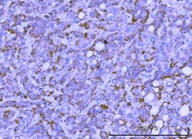 IHC staining of FFPE human liver cancer tissue with TMEM132B antibody. HIER: boil tissue sections in pH8 EDTA for 20 min and allow to cool before testing.