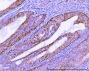 IHC staining of FFPE human endometrioid adenocarcinoma tissue with TMEM132B antibody. HIER: boil tissue sections in pH8 EDTA for 20 min and allow to cool before testing.