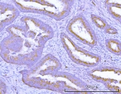 IHC staining of FFPE human colon adenocarcinoma tissue with TMEM132B antibody. HIER: boil tissue sections in pH8 EDTA for 20 min and allow to cool before testing.