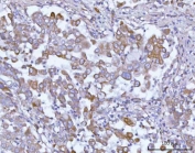 IHC staining of FFPE human lung adenocarcinoma tissue with OSGIN1 antibody. HIER: boil tissue sections in pH8 EDTA for 20 min and allow to cool before testing.