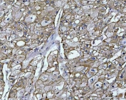IHC staining of FFPE human liver cancer tissue with OSGIN1 antibody. HIER: boil tissue sections in pH8 EDTA for 20 min and allow to cool before testing.