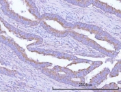 IHC staining of FFPE human colon adenocarcinoma tissue with OSGIN1 antibody. HIER: boil tissue sections in pH8 EDTA for 20 min and allow to cool before testing.