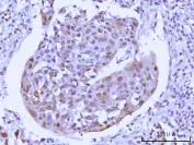 IHC staining of FFPE human esophageal squamous carcinoma tissue with RSBN1 antibody. HIER: boil tissue sections in pH8 EDTA for 20 min and allow to cool before testing.