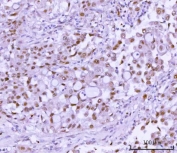 IHC staining of FFPE human lung adenocarcinoma tissue with RSBN1 antibody. HIER: boil tissue sections in pH8 EDTA for 20 min and allow to cool before testing.