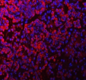 Immunofluorescent staining of FFPE human lung cancer tissue with PACSIN2 antibody (red) and DAPI nuclear stain (blue). HIER: steam section in pH8 EDTA buffer for 20 min.