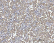 IHC staining of FFPE human testicular seminoma tissue with PACSIN2 antibody. HIER: boil tissue sections in pH8 EDTA for 20 min and allow to cool before testing.
