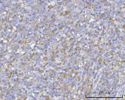 IHC staining of FFPE human intestine diffuse large B-cell lymphoma tissue with PACSIN2 antibody. HIER: boil tissue sections in pH8 EDTA for 20 min and allow to cool before testing.