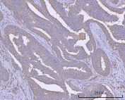 IHC staining of FFPE human colon adenocarcinoma tissue with PACSIN2 antibody. HIER: boil tissue sections in pH8 EDTA for 20 min and allow to cool before testing.