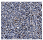 IHC staining of FFPE human lymph node tissue with GSDMD antibody. HIER: boil tissue sections in pH8 EDTA for 20 min and allow to cool before testing.