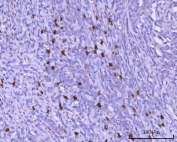 IHC staining of FFPE human lymphoma tissue with PAX5 antibody. HIER: boil tissue sections in pH8 EDTA for 20 min and allow to cool before testing.