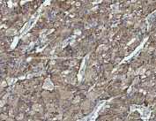 IHC staining of FFPE human liver cancer tissue with OXSM antibody. HIER: boil tissue sections in pH8 EDTA for 20 min and allow to cool before testing.