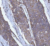 IHC staining of FFPE human esophageal squamous carcinoma tissue with OXSM antibody. HIER: boil tissue sections in pH8 EDTA for 20 min and allow to cool before testing.