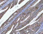 IHC staining of FFPE human endometrial adenocarcinoma tissue with OXSM antibody. HIER: boil tissue sections in pH8 EDTA for 20 min and allow to cool before testing.