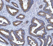 IHC staining of FFPE human colorectal adenocarcinoma tissue with OXSM antibody. HIER: boil tissue sections in pH8 EDTA for 20 min and allow to cool before testing.