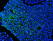 Immunofluorescent staining of FFPE human esophageal squamous cell carcinoma tissue with PITPNB antibody (green) and DAPI nuclear stain (blue). HIER: steam section in pH8 EDTA buffer for 20 min.