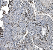IHC staining of FFPE human lung cancer tissue with CD45 antibody. HIER: boil tissue sections in pH8 EDTA for 20 min and allow to cool before testing.