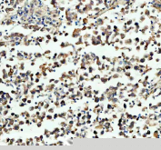 IHC staining of FFPE human testis cancer tissue with PGAM1 antibody, HRP-secondary and DAB substrate. HIER: boil tissue sections in pH8 EDTA for 20 min and allow to cool before testing.