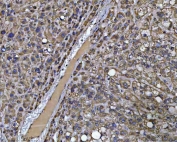IHC staining of FFPE human liver cancer tissue with PCCB antibody. HIER: boil tissue sections in pH8 EDTA for 20 min and allow to cool before testing.