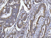 IHC staining of FFPE human colon adenocarcinoma tissue with PCCB antibody. HIER: boil tissue sections in pH8 EDTA for 20 min and allow to cool before testing.