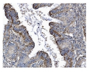 IHC staining of FFPE human cervical intraepithelial neoplasia tissue with GSDMD antibody. HIER: boil tissue sections in pH8 EDTA for 20 min and allow to cool before testing.