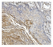IHC staining of FFPE human esophageal squamous carcinoma tissue with GSDMD antibody. HIER: boil tissue sections in pH8 EDTA for 20 min and allow to cool before testing.