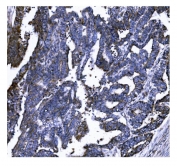 IHC staining of FFPE human cervical cancer tissue with GSDMD antibody. HIER: boil tissue sections in pH8 EDTA for 20 min and allow to cool before testing.