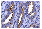 IHC staining of FFPE human gallbladder adenocarcinoma tissue with CD13 antibody. HIER: boil tissue sections in pH8 EDTA for 20 min and allow to cool before testing.