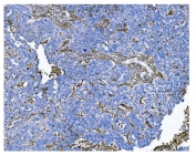 IHC staining of FFPE human ovarian serous adenocarcinoma tissue with CD13 antibody. HIER: boil tissue sections in pH8 EDTA for 20 min and allow to cool before testing.