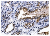 IHC staining of FFPE human renal clear cell carcinoma tissue with CD13 antibody. HIER: boil tissue sections in pH8 EDTA for 20 min and allow to cool before testing.