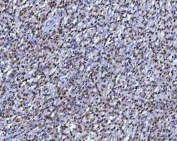 IHC staining of FFPE human B cell lymphoma tissue with RPRD1B antibody. HIER: boil tissue sections in pH8 EDTA for 20 min and allow to cool before testing.
