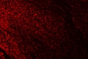 Immunofluorescent staining of FFPE human esophageal squamous cell carcinoma tissue with RPRD1B antibody (red). HIER: steam section in pH8 EDTA buffer for 20 min.