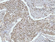 IHC staining of FFPE human esophageal squamous carcinoma tissue with RPRD1B antibody. HIER: boil tissue sections in pH8 EDTA for 20 min and allow to cool before testing.