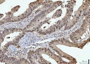 IHC staining of FFPE human rectal cancer tissue with RPRD1B antibody. HIER: boil tissue sections in pH8 EDTA for 20 min and allow to cool before testing.