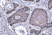 IHC staining of FFPE human esophageal squamous carcinoma tissue with p57Kip2 antibody. HIER: boil tissue sections in pH8 EDTA for 20 min and allow to cool before testing.