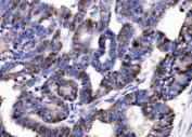 IHC staining of FFPE human cervical cancer tissue with p57Kip2 antibody. HIER: boil tissue sections in pH8 EDTA for 20 min and allow to cool before testing.